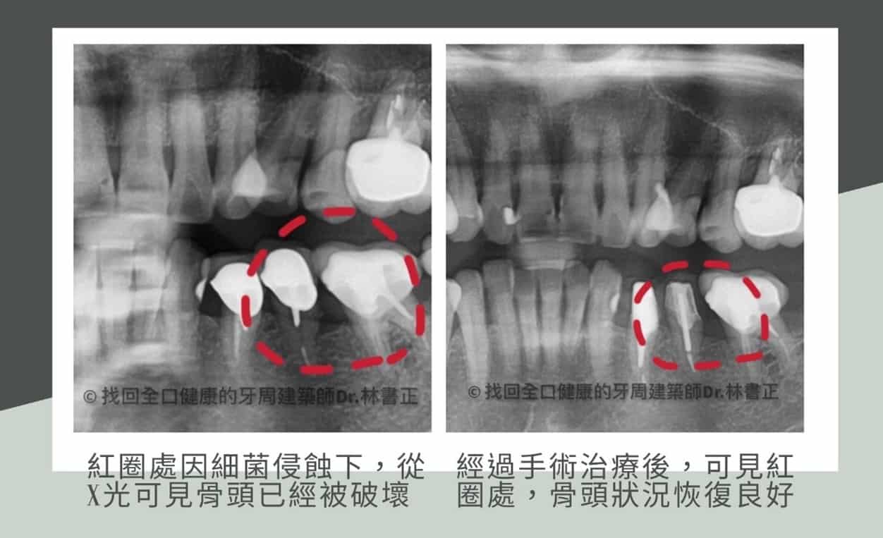 假牙清潔牙周病3